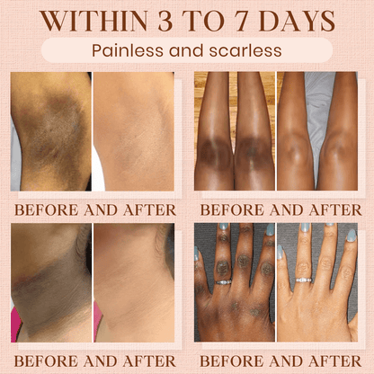 𝐂𝐯𝐫𝐞𝐨𝐳® Purifying Exfoliating Gel for Acanthosis Nigricans, Exfoliation, Dark Spots, Skin Tags, and Eczema_Ultra01
