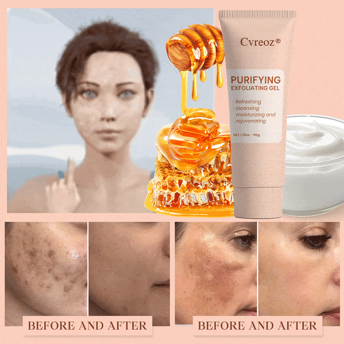 𝐂𝐯𝐫𝐞𝐨𝐳® Purifying Exfoliating Gel for Acanthosis Nigricans, Exfoliation, Dark Spots, Skin Tags, and Eczema_Ultra01