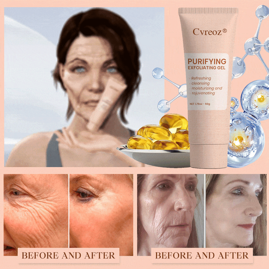 𝐂𝐯𝐫𝐞𝐨𝐳® Purifying Exfoliating Gel for Acanthosis Nigricans, Exfoliation, Dark Spots, Skin Tags, and Eczema_Ultra01