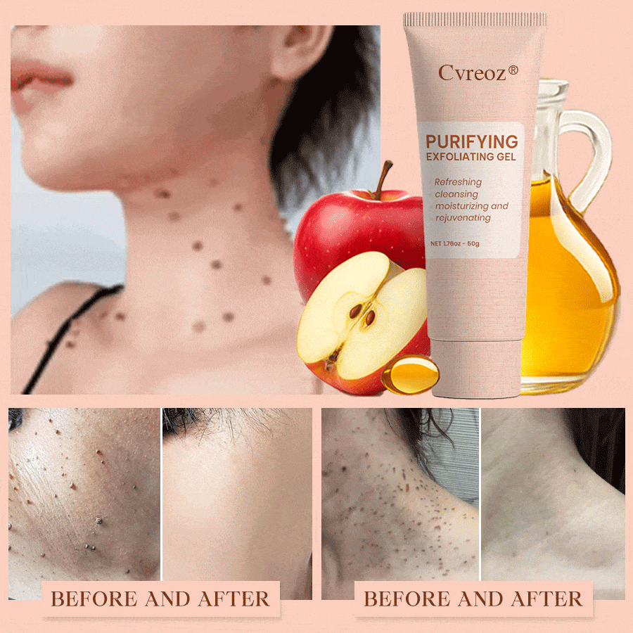 𝐂𝐯𝐫𝐞𝐨𝐳® Purifying Exfoliating Gel for Acanthosis Nigricans, Exfoliation, Dark Spots, Skin Tags, and Eczema_Ultra01