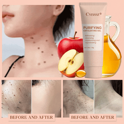 𝐂𝐯𝐫𝐞𝐨𝐳® Purifying Exfoliating Gel for Acanthosis Nigricans, Exfoliation, Dark Spots, Skin Tags, and Eczema_Ultra01