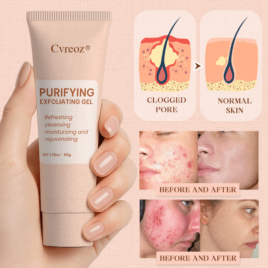 𝐂𝐯𝐫𝐞𝐨𝐳® Purifying Exfoliating Gel for Acanthosis Nigricans, Exfoliation, Dark Spots, Skin Tags, and Eczema_Ultra01
